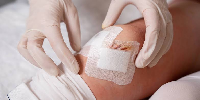 Wound Dressing